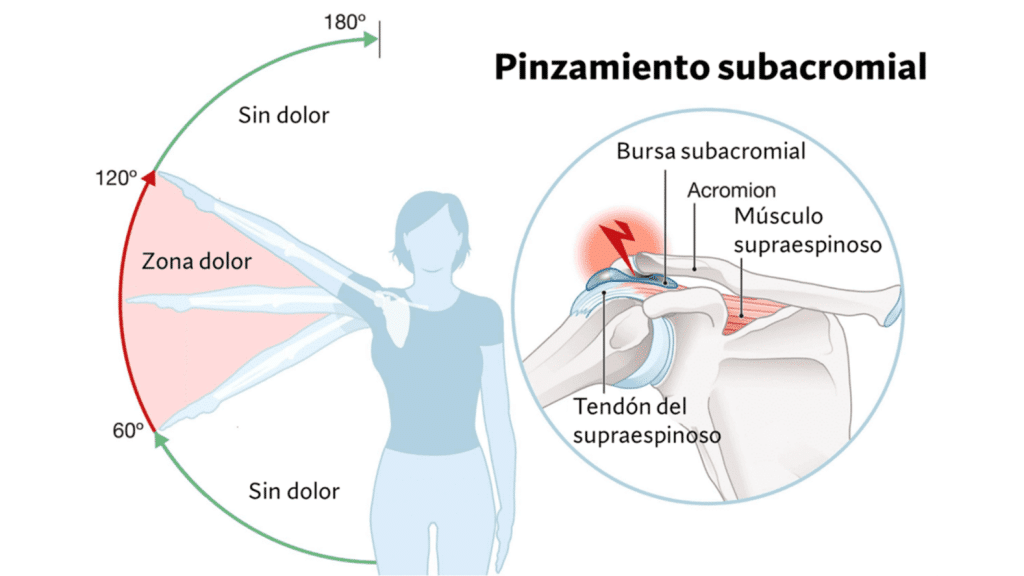 5 errores que debes evitar al entrenar tus hombros 5 » Tienda VitaSport Dolor y fisiopatología pinzamiento subacromial